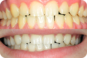 Whitening 1