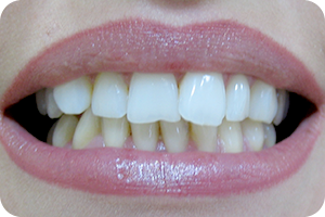 Whitening 2