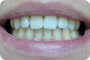 Whitening 3