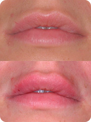 Hyaluronic FIller 1