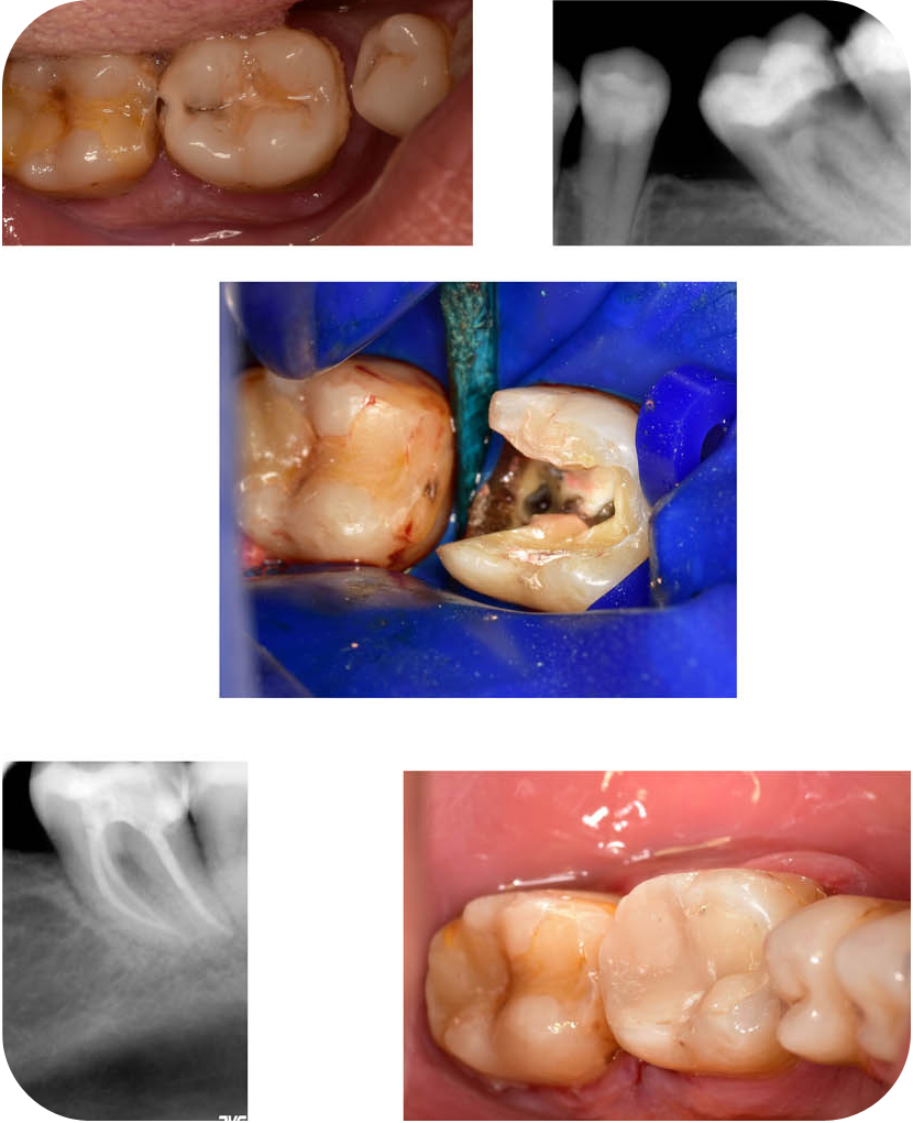 conservative-composite fillings