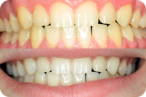 Beljenje zuba 1