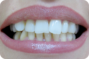 Beljenje zuba 2