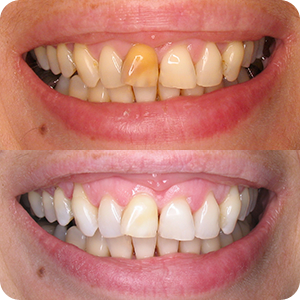 Beljenje zuba - Endodontsko beljenje