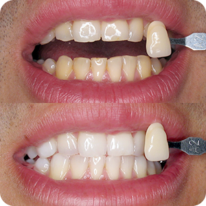 Beljenje zuba - Lasersko Beljenje