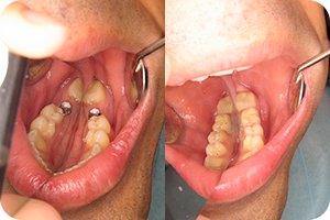 Oralna hirurgija 3