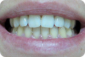 Beljenje zuba 3