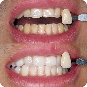 Beljenje zuba - Lasersko Beljenje